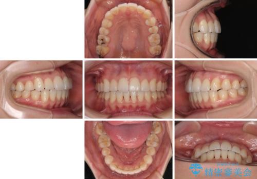 前歯のデコボコと口元の膨らみを治したい ワイヤー装置での非抜歯矯正の治療後