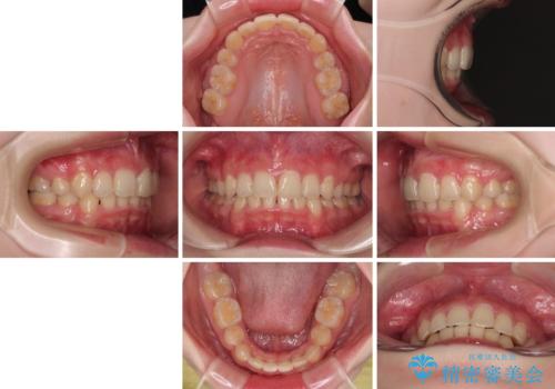 【モニター】デコボコと隠れてしまう前歯 ワイヤー装置による抜歯矯正で美しい口元にの治療後