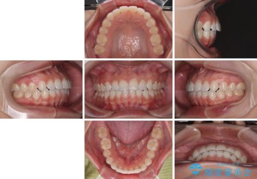 【モニター】マウスピース矯正が煩わしい ワイヤー装置での非抜歯矯正の治療後