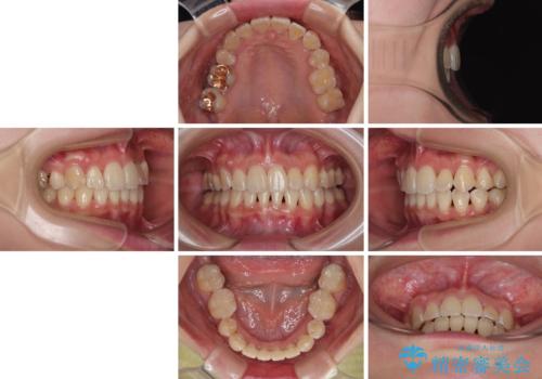 【モニター】前歯のデコボコをワイヤーの抜歯矯正で綺麗に整えるの治療後