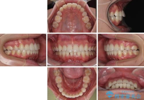 【モニター】八重歯とデコボコを治したい 補助装置を併用したワイヤー矯正の治療後