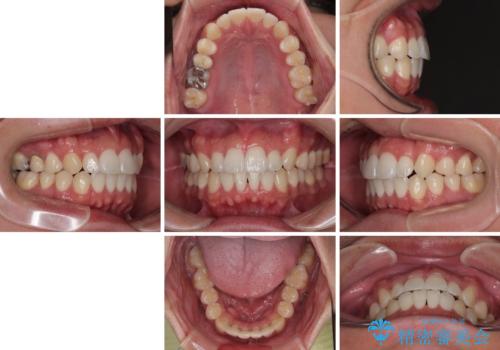 前歯のデコボコをささっと治す 短期間でのインビザライン矯正治療の治療後
