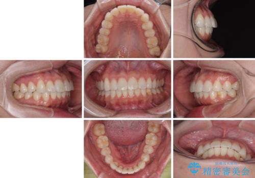 気になる前歯を短期間で治す インビザライン・モデレートでの矯正治療の治療後