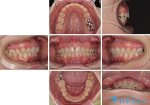 出っ歯を治したい ワイヤー装置での抜歯矯正の治療後