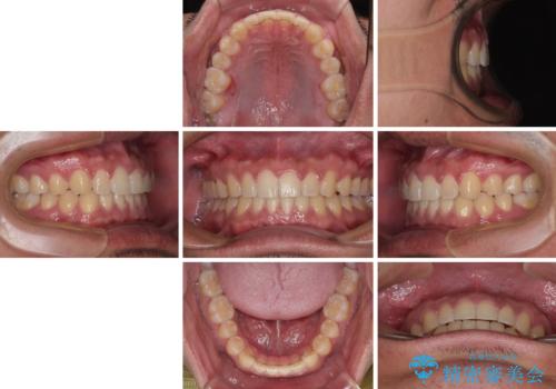 隙間だらけの歯列を治したい ワイヤー矯正での矯正治療の治療後