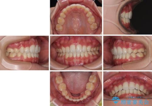 横顔の印象を改善したい ワイヤー装置での抜歯矯正の治療後