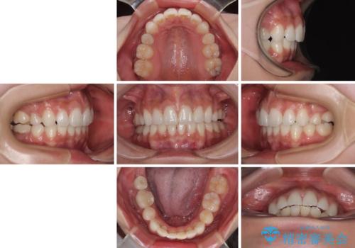 膨らんだ口元を改善する抜歯矯正 インプラント治療も同時に行う総合歯科治療の治療後