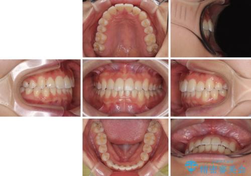 前歯のクロスバイト 裏側に隠れた歯をワイヤー装置で短期間治療の治療後