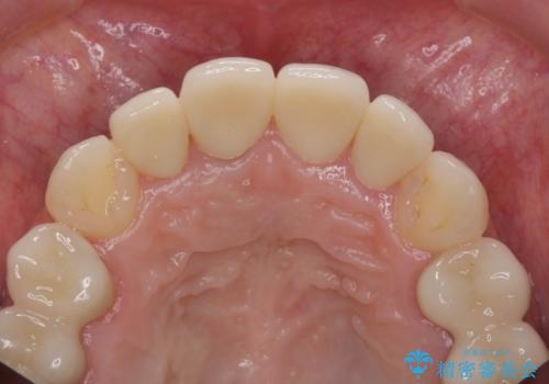 虫歯だらけの前歯をセラミック治療の治療後