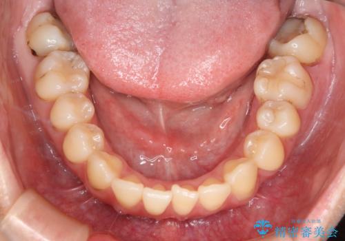 下の前歯のガタつきを治したい インビザライン・ライトパッケージの治療前