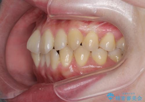 前歯のねじれ 矯正治療による歯並び改善の治療前