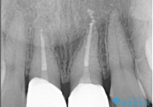 前歯の色が気になる!|他院で抜歯と言われた|歯を残したい|精密根管治療とオールセラミッククラウンで治療の治療後