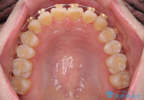 前歯のねじれ 矯正治療による歯並び改善の治療中