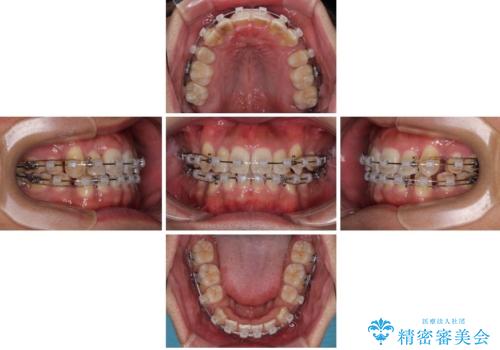 八重歯と前歯のガタガタを抜歯矯正で治療|クリアブラケット使用例の治療中