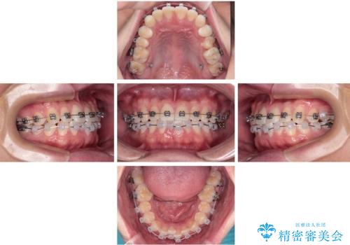 前歯のガタガタ・奥歯のかみ合わせ(シザーズバイト)を改善|1年半で完了したメタルブラケット矯正の治療中