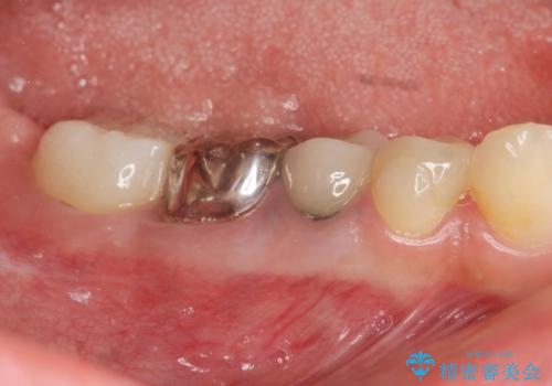 遊離歯肉移植術を伴うインプラント治療の症例 治療前