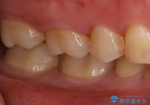 奥歯の虫歯を治療したい セラミックインレーの治療中