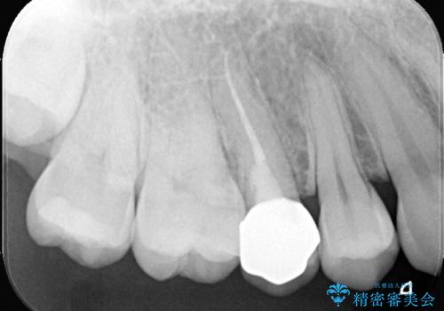 【根管治療】【セラミッククラウン】根っこが細くて治療できないと言われたの治療後