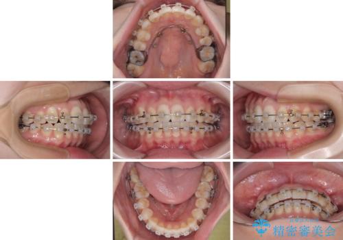 前歯のデコボコと口元の膨らみを治したい ワイヤー装置での非抜歯矯正の治療中