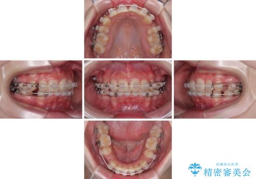 【モニター】デコボコと隠れてしまう前歯 ワイヤー装置による抜歯矯正で美しい口元にの治療中