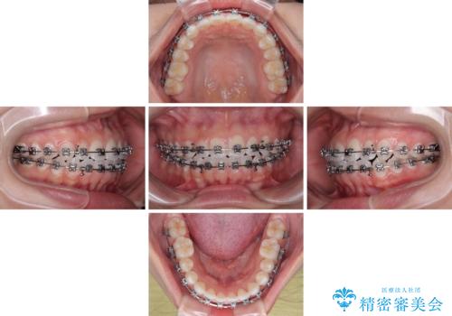 【モニター】マウスピース矯正が煩わしい ワイヤー装置での非抜歯矯正の治療中