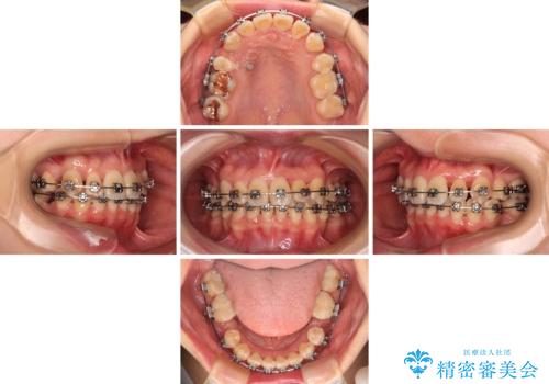 【モニター】前歯のデコボコをワイヤーの抜歯矯正で綺麗に整えるの治療中