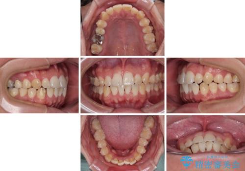 前歯のデコボコをささっと治す 短期間でのインビザライン矯正治療の治療中