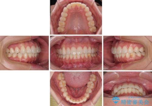 気になる前歯を短期間で治す インビザライン・モデレートでの矯正治療の治療中