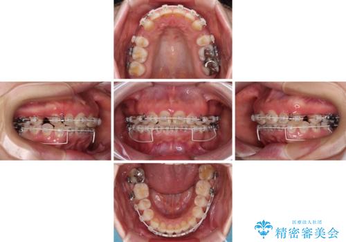 出っ歯を治したい ワイヤー装置での抜歯矯正の治療中