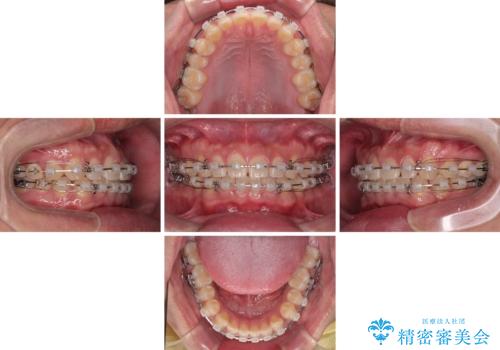 隙間だらけの歯列を治したい ワイヤー矯正での矯正治療の治療中