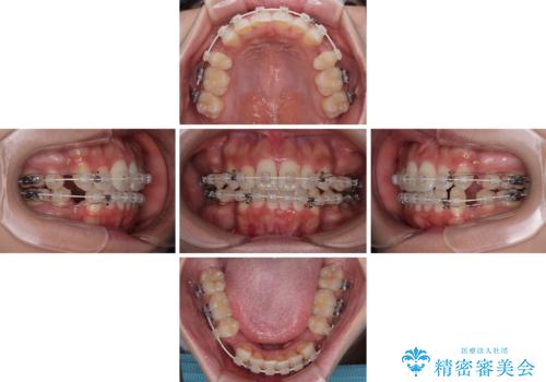 横顔の印象を改善したい ワイヤー装置での抜歯矯正の治療中