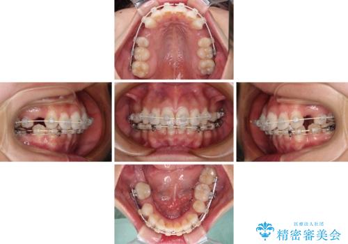 膨らんだ口元を改善する抜歯矯正 インプラント治療も同時に行う総合歯科治療の治療中