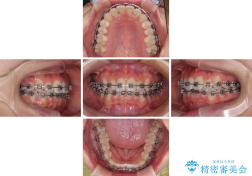 前歯のクロスバイト 裏側に隠れた歯をワイヤー装置で短期間治療の治療中
