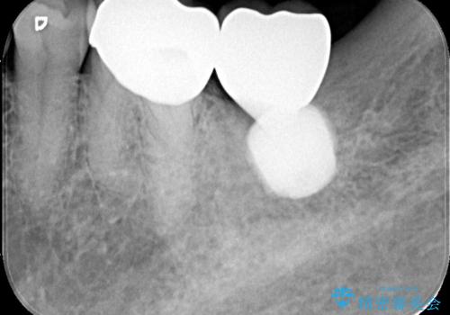 エンドペリオ病変と虫歯を同時に改善したインプラント・セラミック治療症例の治療後