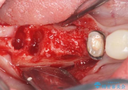 遊離歯肉移植術を伴うインプラント治療の治療前