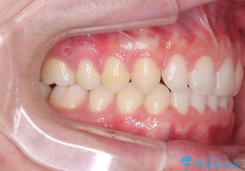 【ワイヤー矯正】歯列の隙間を閉じたいの治療後