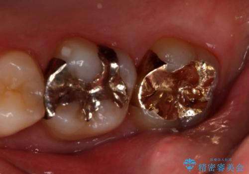 奥歯の再治療をしたい　ゴールドインレーの症例 治療後