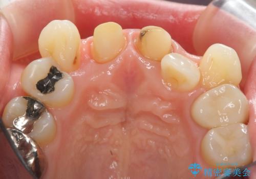 著しいがたつきによる清掃困難 歯牙抜去とセラミック治療の治療中