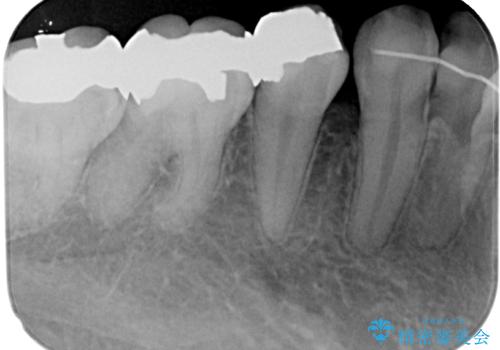 銀歯を白くしたい フルジルコニアクラウンの治療前