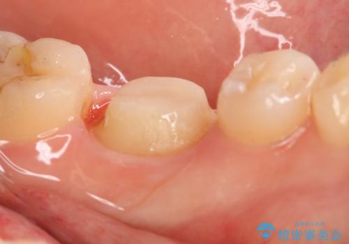 左下奥歯が腫れて痛い フルジルコニアクラウンの治療中