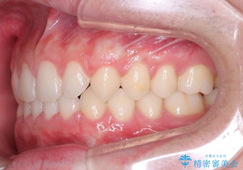 【ワイヤー矯正】歯列の隙間を閉じたいの治療後