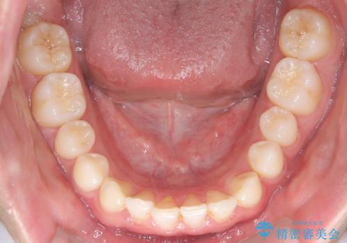 【ワイヤー矯正】歯列の隙間を閉じたいの治療前