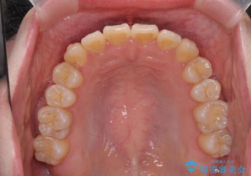 前歯のねじれ 矯正治療による歯並び改善の治療中