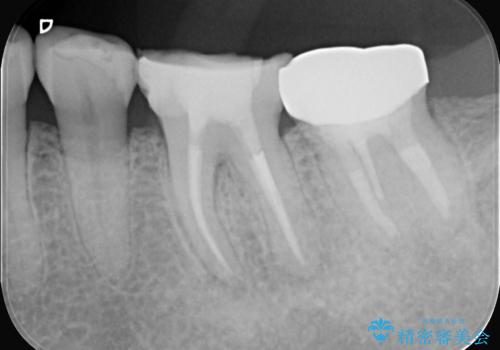 奥歯の痛みも、顕微鏡で精密に解消の治療中