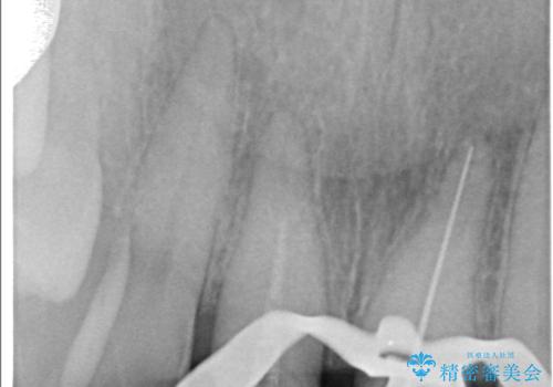 前歯の色が気になる!|他院で抜歯と言われた|歯を残したい|精密根管治療とオールセラミッククラウンで治療の治療中