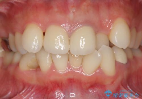 著しいがたつきによる清掃困難 歯牙抜去とセラミック治療の治療後
