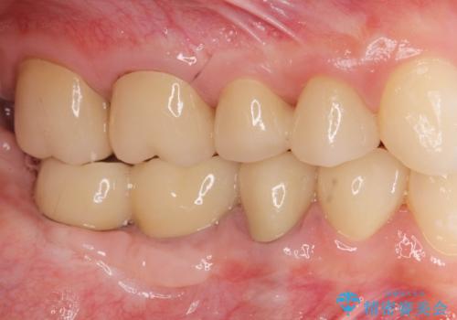 遊離歯肉移植術を伴うインプラント治療の治療後