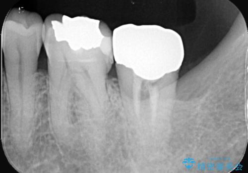 エンドペリオ病変と虫歯を同時に改善したインプラント・セラミック治療症例の治療前