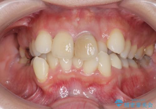 著しいがたつきによる清掃困難 歯牙抜去とセラミック治療の治療前