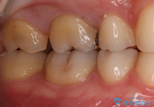 奥歯の再治療をしたい ゴールドインレーの治療中